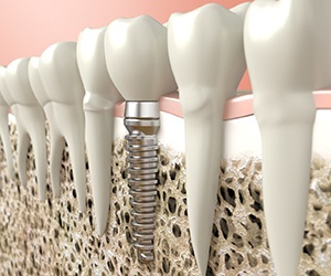 Animated dental implant in the jawbone