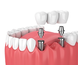 Diagram showing the steps toward dental implant restoration
