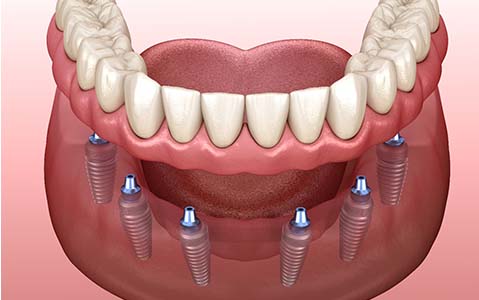 Implant dentures that are going to last a long time
