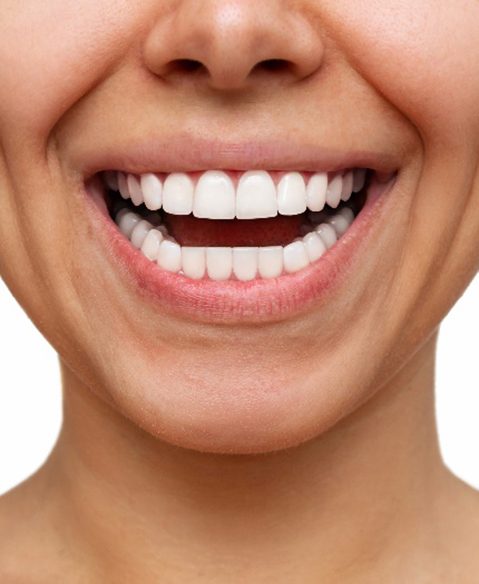 Patient's smile before and after veneers